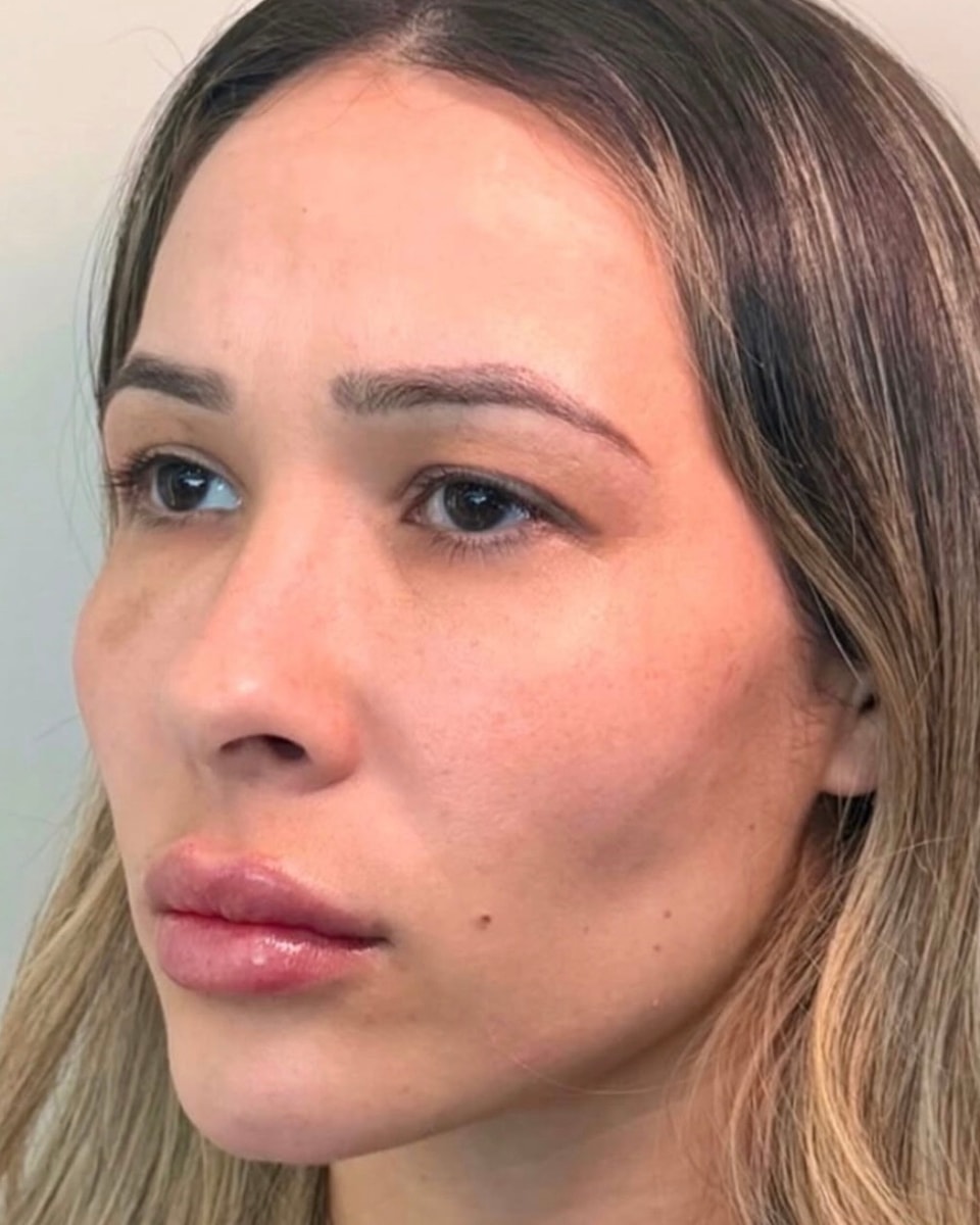 Rostro de una paciente en tres cuartos, después del tratamiento